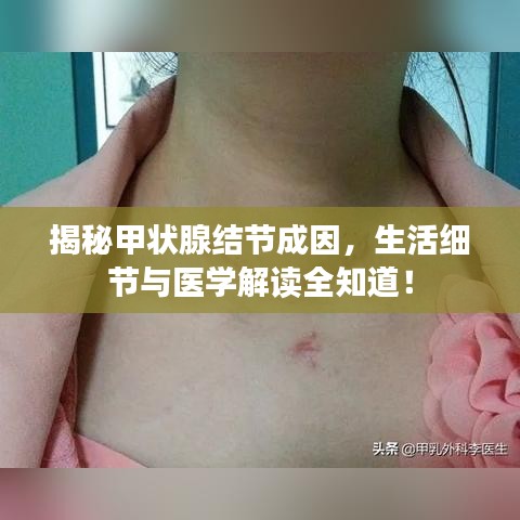 揭秘甲状腺结节成因，生活细节与医学解读全知道！