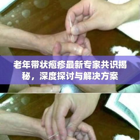 老年带状疱疹最新专家共识揭秘，深度探讨与解决方案