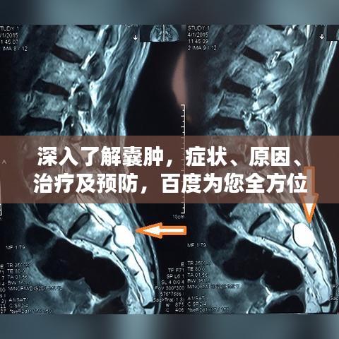 深入了解囊肿，症状、原因、治疗及预防，百度为您全方位解析！